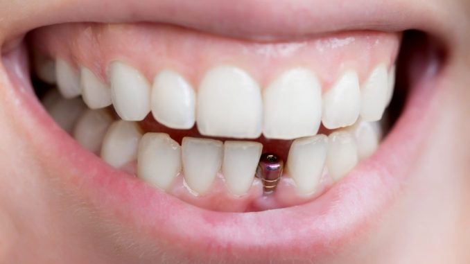 Implants dentaires à petit prix en Hongrie et en Espagne