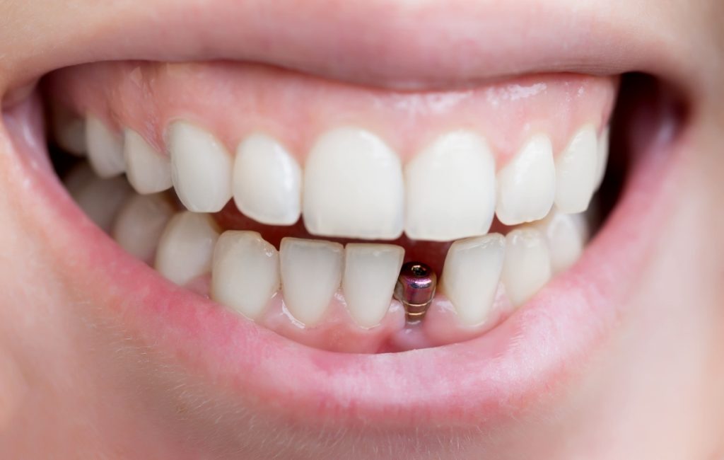Implants dentaires à petit prix en Hongrie et en Espagne